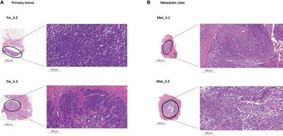 Assessment of aggressive bladder cancer mutations in plasma cell-free DNA
